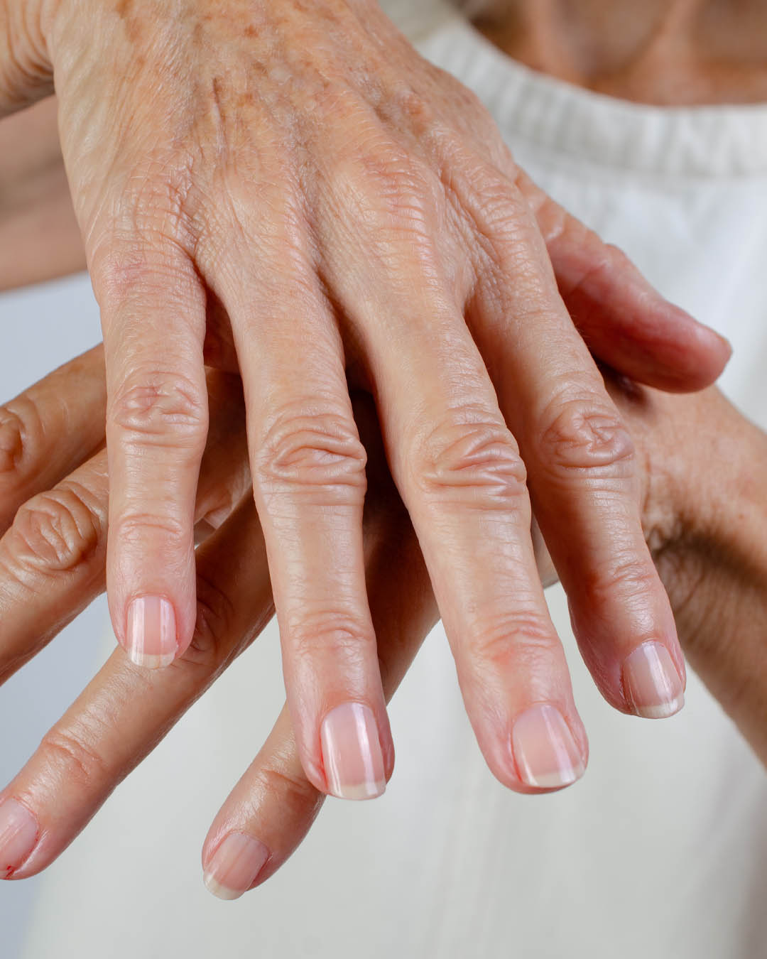 Fair skin tone hand with Smooth Base Ridge filler